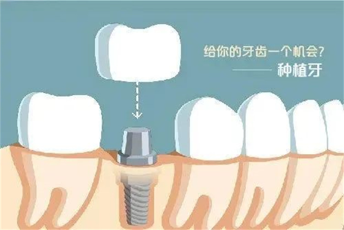 种植牙科普 | 种植牙的优势有哪些呢？